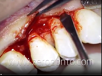 Mucogingival surgery: coronally advanced flap