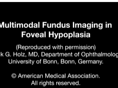 Multimodal Fungus Imaging in Foveal Hypoplasia Multimodal Fungus Imaging in Foveal Hypoplasia