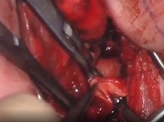 Muscle-sparing extrapleural repair of neonatal aortic coarctation