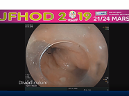 Myotomie et septotomie per-orales endoscopiques (POEM-S) des diverticules sophagiens : une alternative mini-invasive à la chirurgie