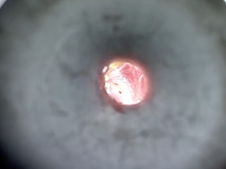 Myringotomy with pressure equalization tube placement