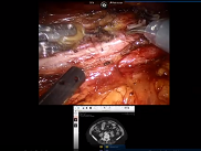 Néphrectomie Partielle Robot de rattrapage post cryoablation