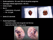 Néphrectomie Partielle Robot tumeur endosinusale