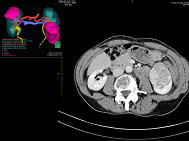 Néphrectomie Partielle Robot tumeurs bilat synchrones