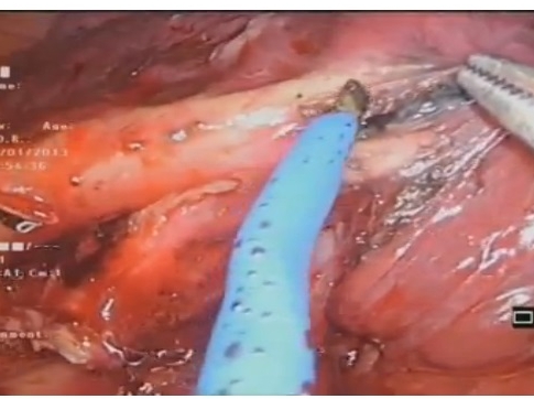 N1 curage dans UNIPORT VATS lobectomie