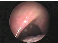 Nasal Fiberoptic Endoscopy of the Larynx and Pharynx at Day 4 in a Patient With Stevens-Johnson Synd