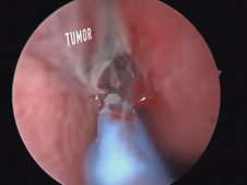 Nasoseptal flap for skull base reconstruction