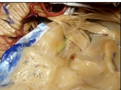 Navigating the Temporal Bone (3D) - Part 1 of 3