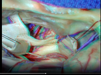 Navigating the Temporal Bone (3D) - Part 2 of 3 Navigating the Temporal Bone (3D) - Part 2 of 3