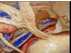 Navigating the Temporal Bone (3D) - Part 2 of 3