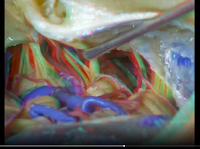 Navigating the Temporal Bone (3D) - Part 3 of 3 Navigating the Temporal Bone (3D) - Part 3 of 3