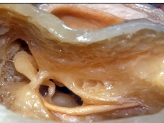 Navigating the Temporal Bone (3D) - Part 3 of 3