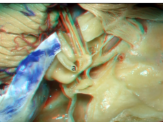 Navigating the Temporal Bone - Part 1 of 3