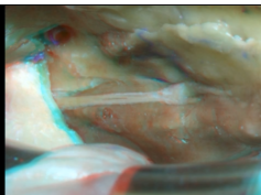 Navigating the Temporal Bone - Part 2 of 3