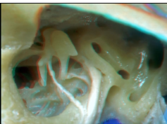 Navigating the Temporal Bone - Part 3 of 3