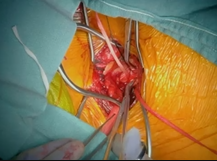 Navion Thoracic Stent Graft for Post Coarctation Repair Aneurysm Navion Thoracic Stent Graft for Post Coarctation Repair Aneurysm
