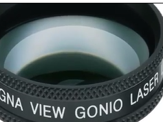 Nd:YAG Laser Goniopuncture Performed on the Eye Shown in Figure 2 Nd:YAG Laser Goniopuncture Performed on the Eye Shown in Figure 2