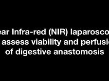 Near Infra-red (NIR) Laparoscopic Assessment of Perfusion Sufficiency of Digestive Anastomosis Near Infra-red (NIR) Laparoscopic Assessment of Perfusion Sufficiency of Digestive Anastomosis