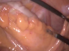 Near-infrared Laparoscopic PINPOINT Fluorescence for Pelvic Side Wall Node Mapping in Rectal Cancer Near-infrared Laparoscopic PINPOINT Fluorescence for Pelvic Side Wall Node Mapping in Rectal Cancer