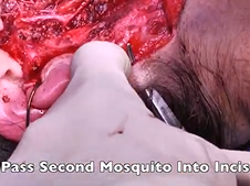 Neck Surgical Drain Placement