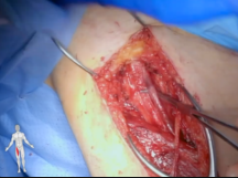Neo-Aortoiliac Reconstruction Neo-Aortoiliac Reconstruction