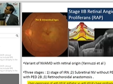 Neovascular Age Related Macular Degeneration Speaker: Prof. (Dr.) Atul Kumar