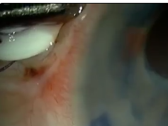 Neovascular Glaucoma Treatment With Extraction of Anterior Chamber Fibrovascular Tissue Neovascular Glaucoma Treatment With Extraction of Anterior Chamber Fibrovascular Tissue