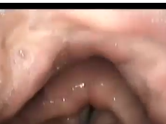 Nerve-Muscle Pedicle Flap Implantation Combined With Arytenoid Adduction