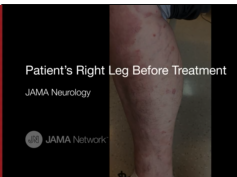 Neuromyotonia Due to Autoimmune Isaacs Syndrome in a Patient With Psoriasis Neuromyotonia Due to Autoimmune Isaacs Syndrome in a Patient With Psoriasis