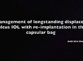 videousa/2016/2016-AAO/New_Technique_for_Management_of_Long-standing_Displaced_Sulcus_IOL-MORKOS.mp4 videousa/2016/2016-AAO/New_Technique_for_Management_of_Long-standing_Displaced_Sulcus_IOL-MORKOS.mp4