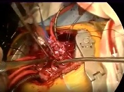 Nikaidoh operation for transposition of the great arteries