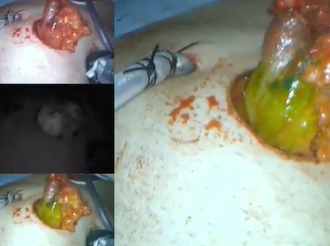 NIR-ICG and Fluorescence Angiography to Detect and Correct Stoma Ischaemia Intraoperatively NIR-ICG and Fluorescence Angiography to Detect and Correct Stoma Ischaemia Intraoperatively