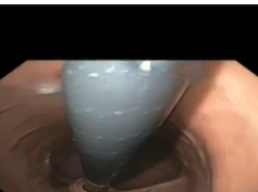 Nissen Fundoplication - 2