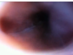 Nissen Fundoplication Wrap Follow Up