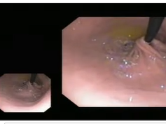 Nissen Fundoplication