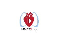 Non-fasting, tubeless, minimally invasive esophagectomy Non-fasting, tubeless, minimally invasive esophagectomy