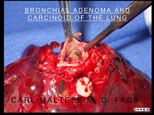 Non-Small cell lung cancer Non-Small cell lung cancer