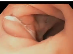 Normal Sleeve Gastrectomy