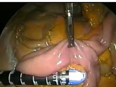 NOTES: Cadaveric Rendezvous Hybrid Small Bowel Resection NOTES: Cadaveric Rendezvous Hybrid Small Bowel Resection