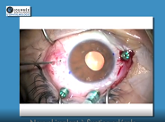 Nouvel implant suturé à la sclère
