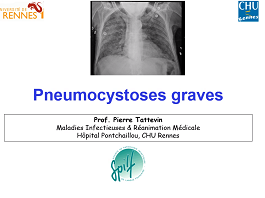 Nouvelles problématiques dans les infections fongiques -Pneumocystose grave