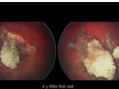 Nystagmus Resolution Following Retinoblastoma Treatment Nystagmus Resolution Following Retinoblastoma Treatment