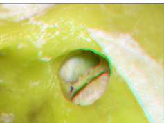 Obitozygomatic Approaches (3D Anaglyph)