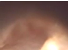 Objective Tinnitus From Middle Ear Myoclonus