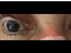 Ocular Dipping in Anoxic Brain Injury Ocular Dipping in Anoxic Brain Injury