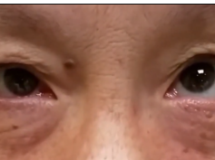 Ocular Neuromyotonia After Pituitary Adenoma Resection Ocular Neuromyotonia After Pituitary Adenoma Resection