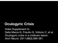 Oculogyric Crisis Oculogyric Crisis