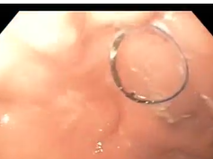 Old Stamm Gastroscomy Site