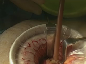 On Table Lavage in Laparoscopic Management of Closed Loop Large Bowel Obstruction On Table Lavage in Laparoscopic Management of Closed Loop Large Bowel Obstruction