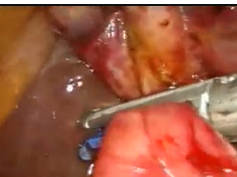 One Shot Treatment Of Acute Cholecystitis Associated With Cholecystoduodenal Fistula And Common Bi One Shot Treatment Of Acute Cholecystitis Associated With Cholecystoduodenal Fistula And Common Bi